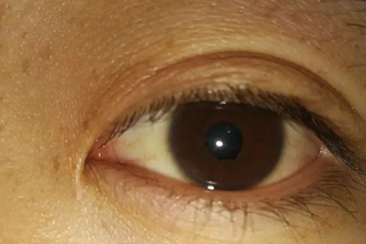 Argyll-Robertson-瞳孔图