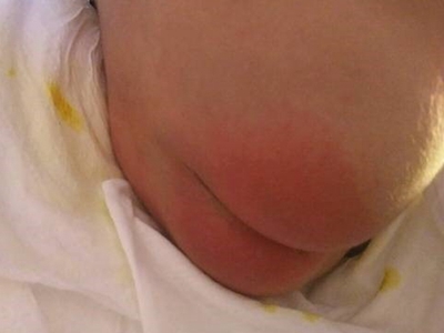 婴儿尿布疹屁股红了一大片图.jpeg