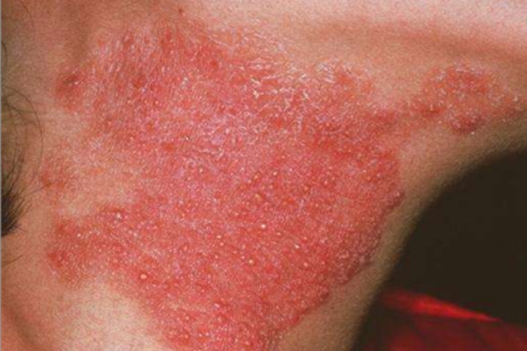 寻常狼疮侧颈症状图