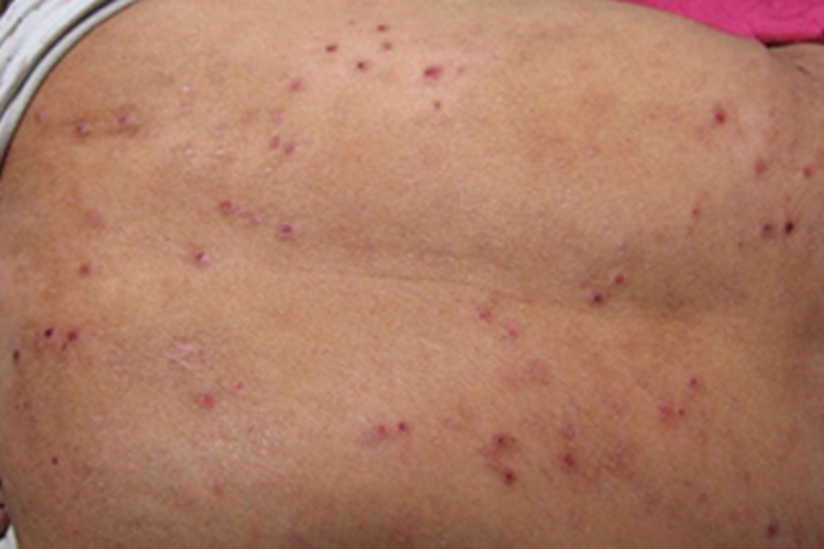 痒疹背部丘疹图
