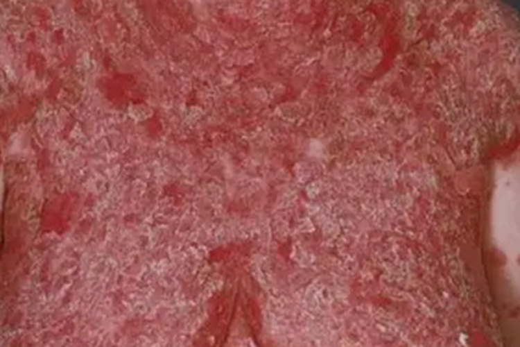 妊娠疱疹胸部症状图