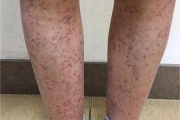 皮下出血小腿紫癜图