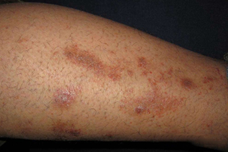 血管萎缩性皮肤异色病小腿褐斑图 血管萎缩性皮肤异色病小腿褐斑图