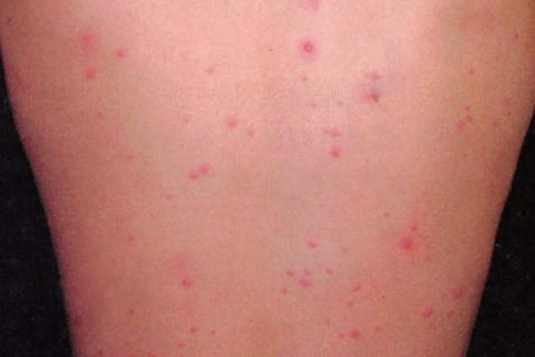 水痘丘疹红斑图