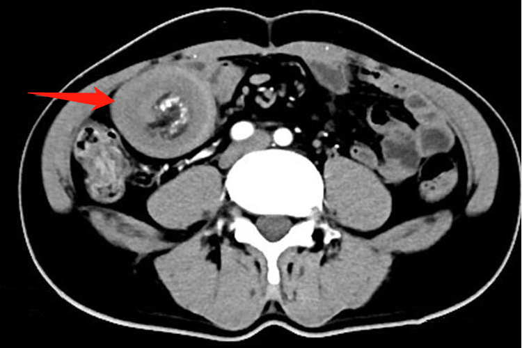 胃肠道间质瘤合并肠套叠CT图