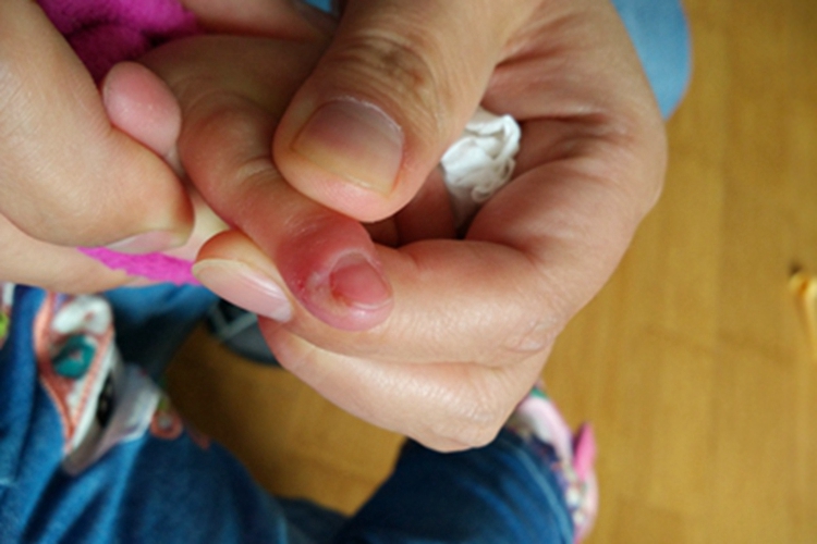 甲床炎手指红肿图