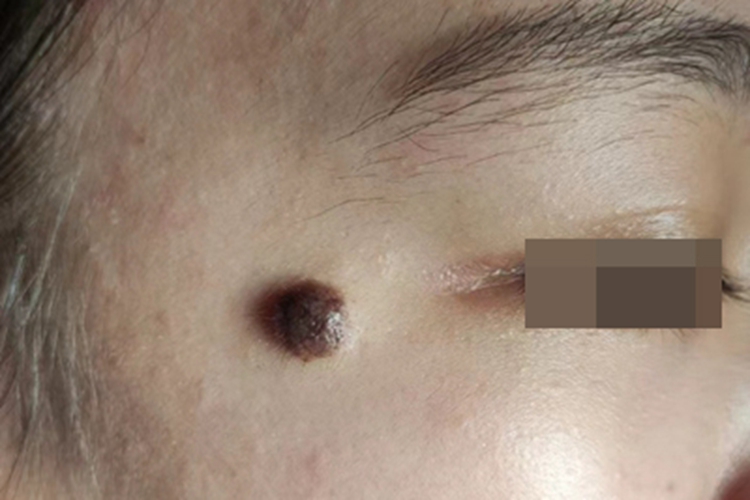 交界痣面部痣图 交界痣面部痣图