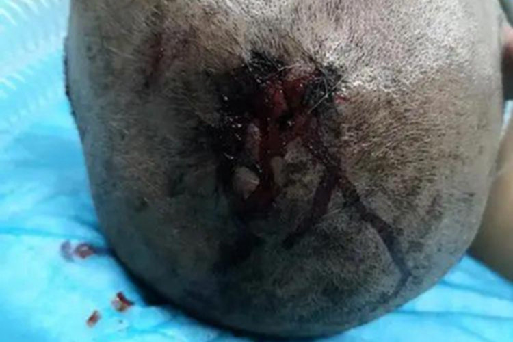 开放性颅脑损伤头顶伤口出血图