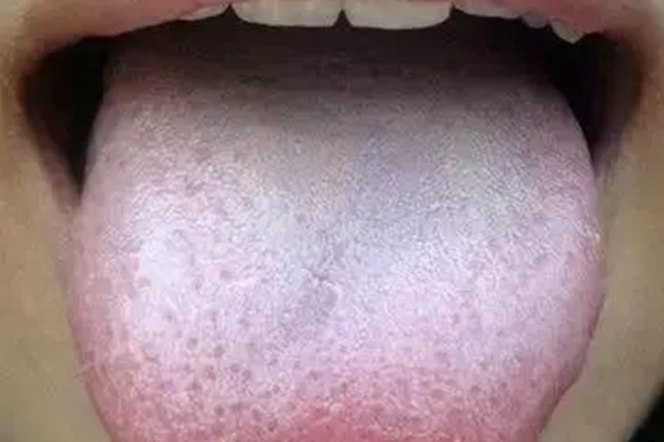 严重肾阳虚的舌头图
