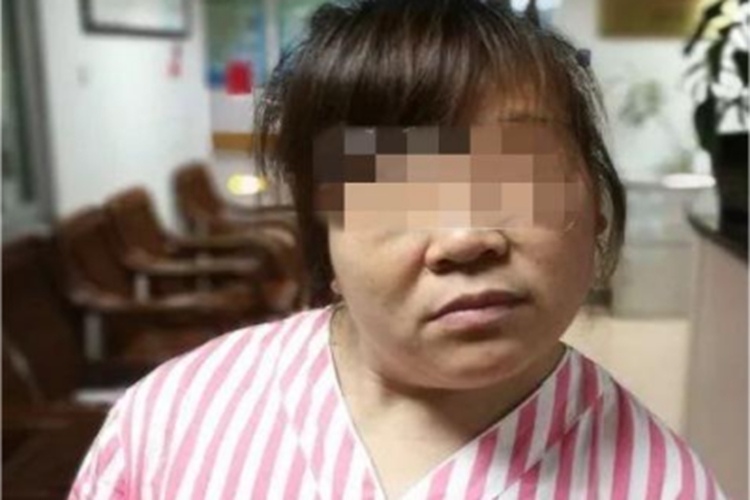 先天性肌性斜颈歪脖子图