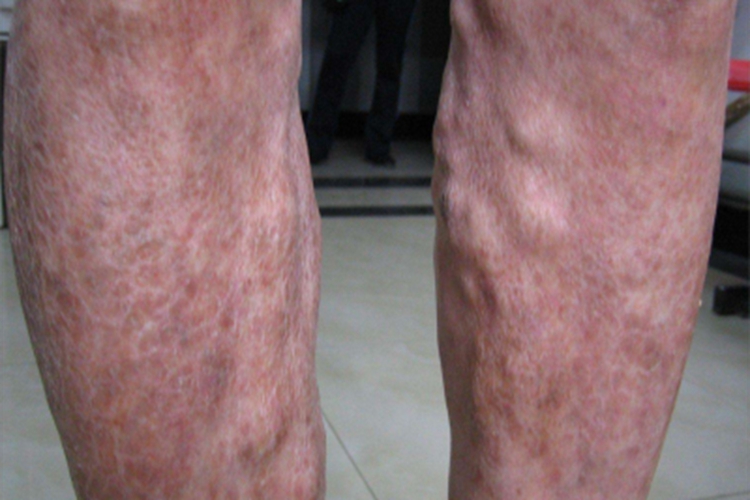 淤积性皮炎小腿发红图