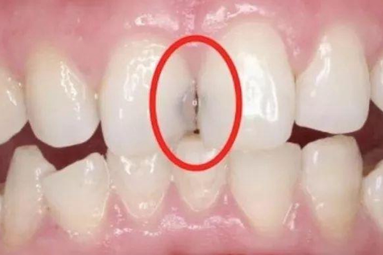 门牙邻面龋中龋图