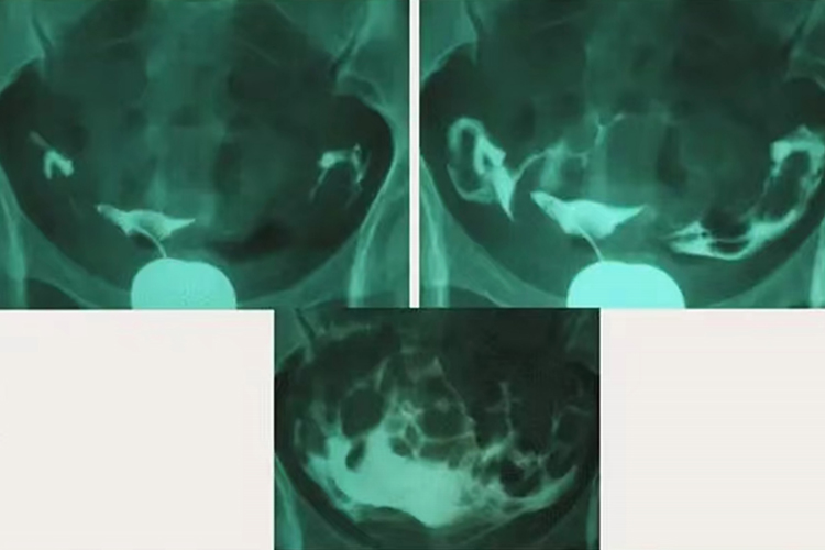 超声下正常子宫输卵管造影图