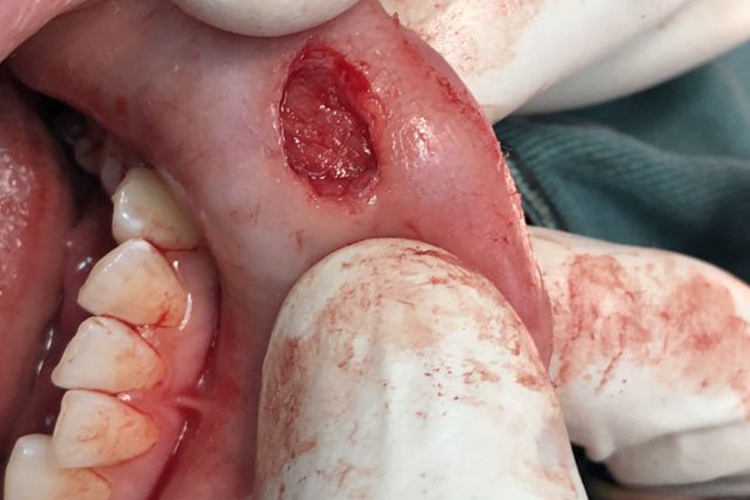 黏液腺囊肿取出囊肿图