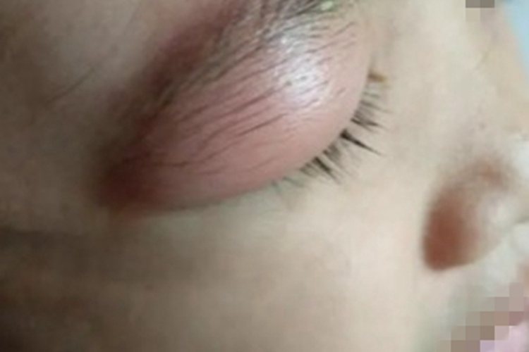 眼眶淋巴瘤上眼睑红肿图