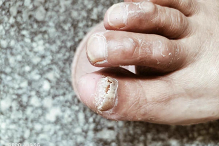 全甲损毁型甲真菌病脚趾甲缺损图