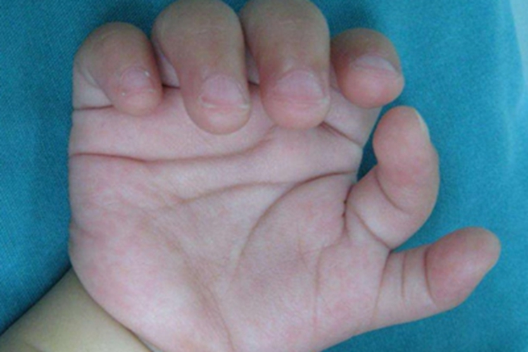 唐氏综合征多指畸形图 唐氏综合征多指畸形图