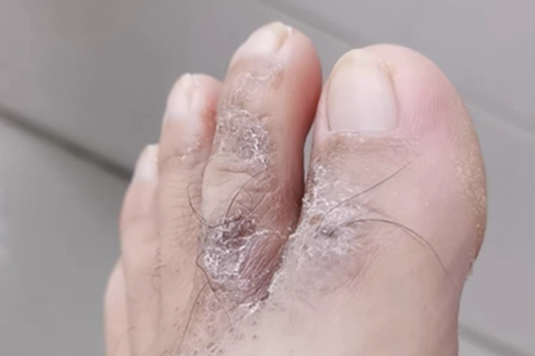 鳞屑角化型足癣脚趾结痂图