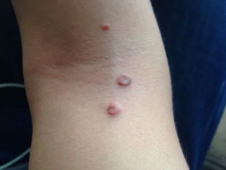 艾滋病初期身上寻常疣图