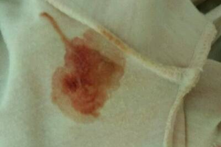 放置曼月乐环点滴出血一个月图