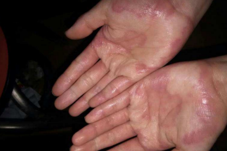 浸渍糜烂型手指真菌感染图 浸渍糜烂型手指真菌感染图