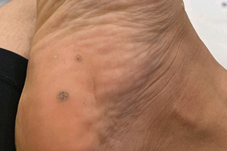 寻常疣脚后跟有丘疹图