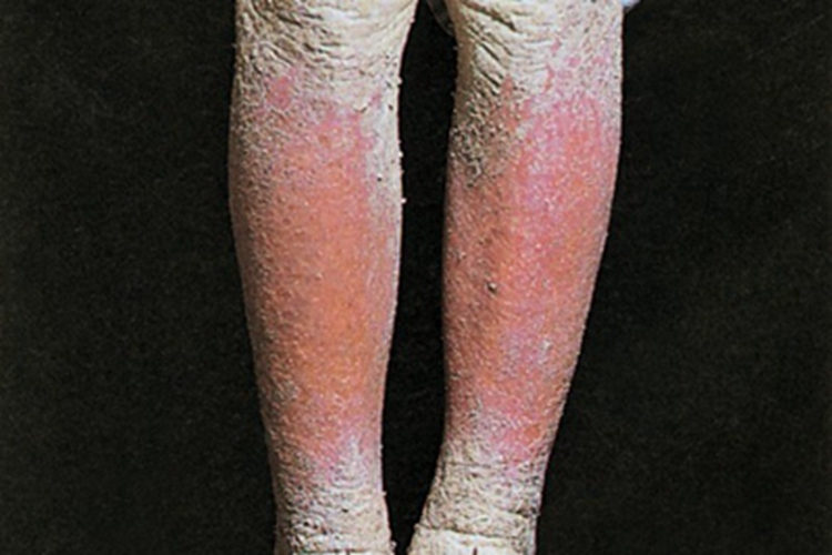 结痂性疥疮小腿结痂图 结痂性疥疮小腿结痂图