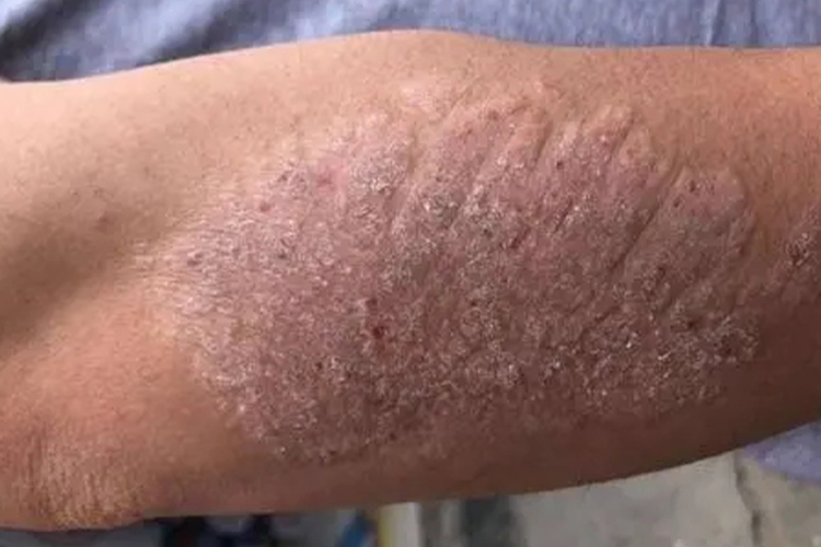 手臂慢性单纯性苔藓图 手臂慢性单纯性苔藓图