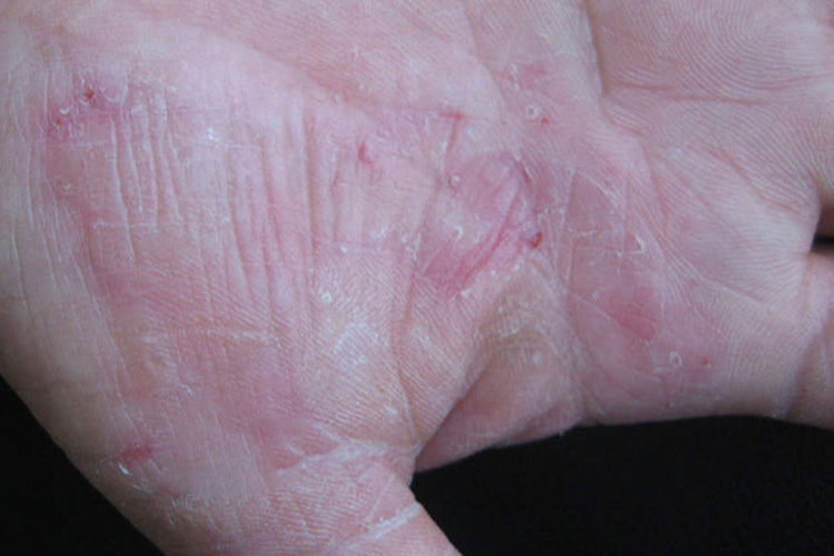 掌心早期水疱型手癣图