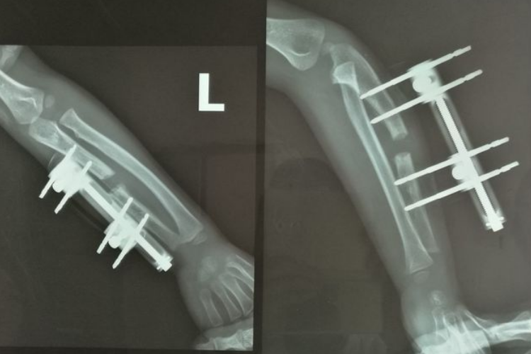 骨延长纤维骨痂开始出现图