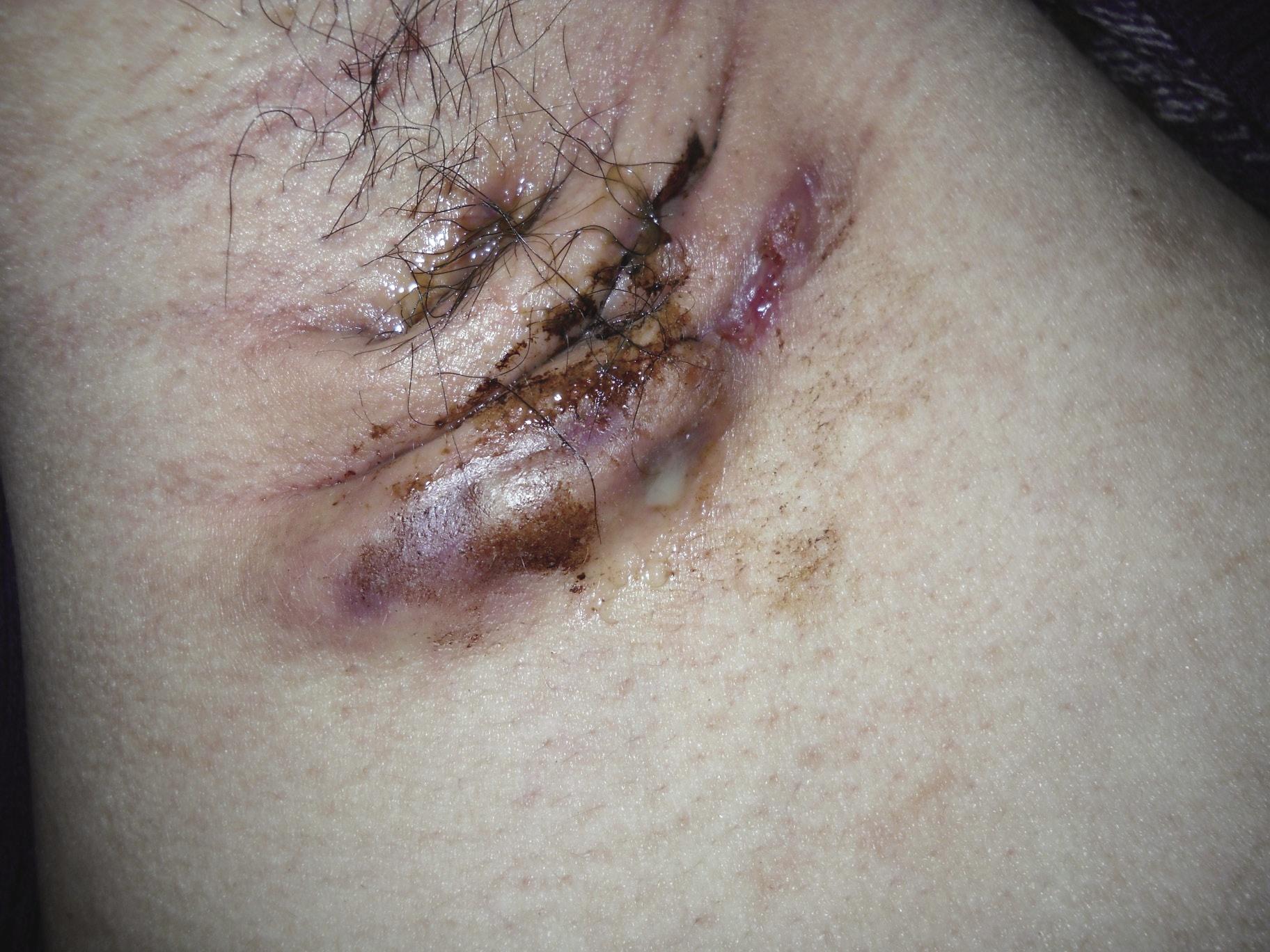 化脓性汗腺炎图