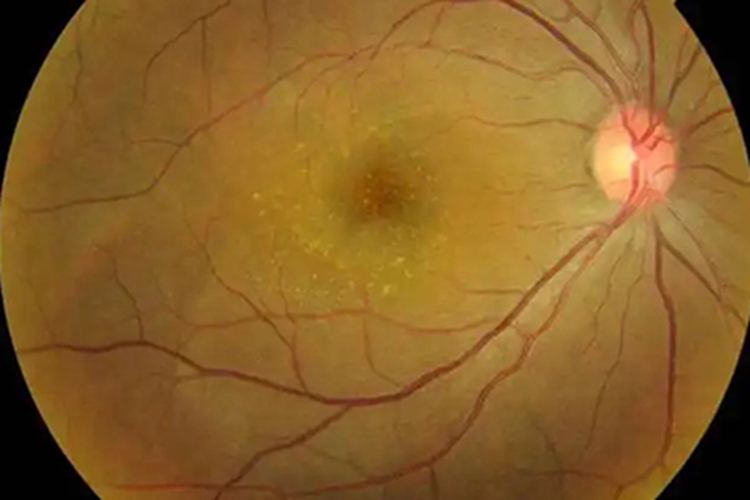 视网膜脉络膜炎白斑图 视网膜脉络膜炎白斑图