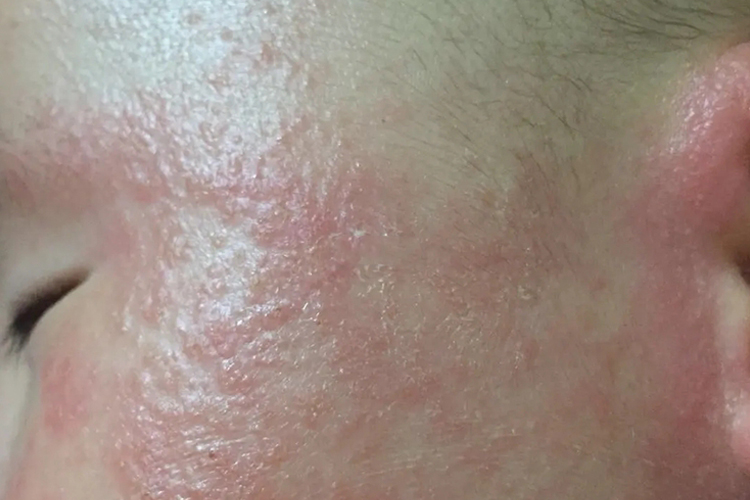 急性湿疹眼周丘疹图 急性湿疹眼周丘疹图