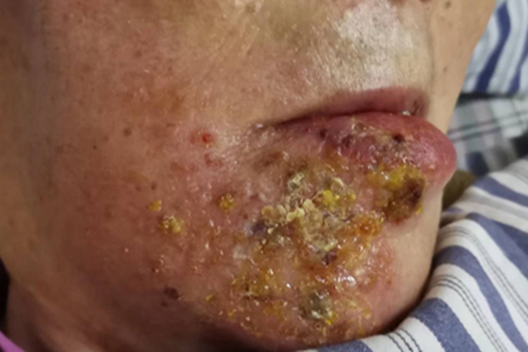 蜂窝织炎下巴许多黄痂图