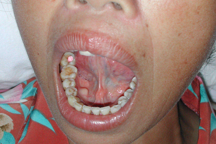 下颌隆突图 下颌隆突图