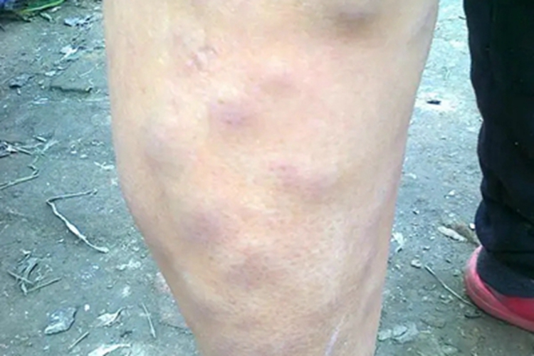 结节性脂膜炎小腿包块图 结节性脂膜炎小腿包块图