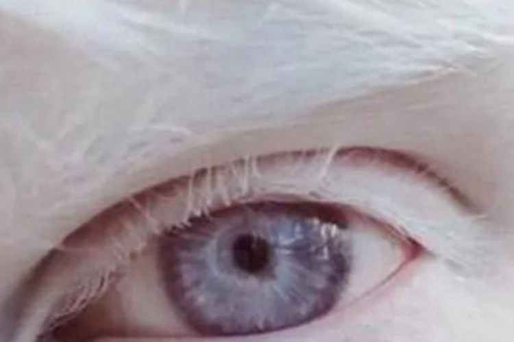 眼白化病瞳孔颜色变浅图