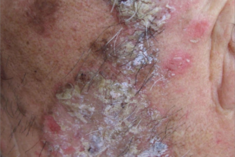 增殖性皮炎结痂图 增殖性皮炎结痂图