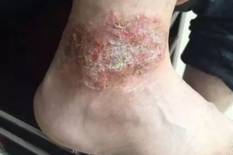 钱币状湿疹脚踝脱皮图 钱币状湿疹脚踝脱皮图