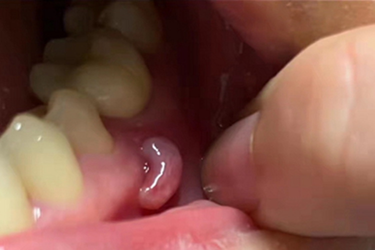 慢性根尖周炎牙龈包块图 慢性根尖周炎牙龈包块图