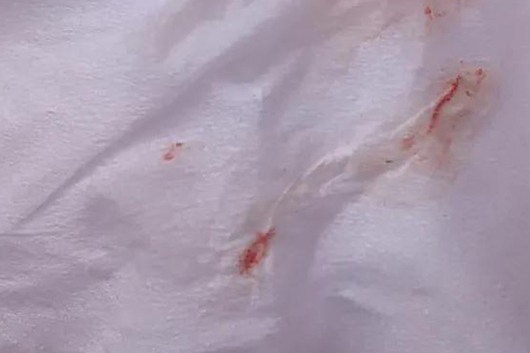 鼻涕带血性分泌物图