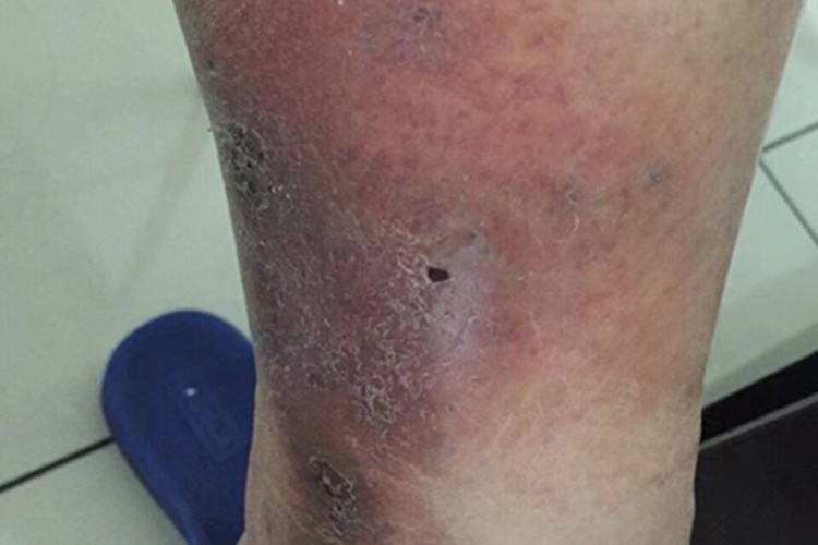 慢性期硬化性脂膜炎小腿症状图 慢性期硬化性脂膜炎小腿症状图