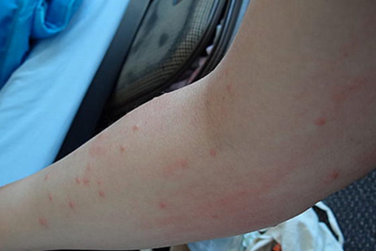 体虱病胳膊症状图