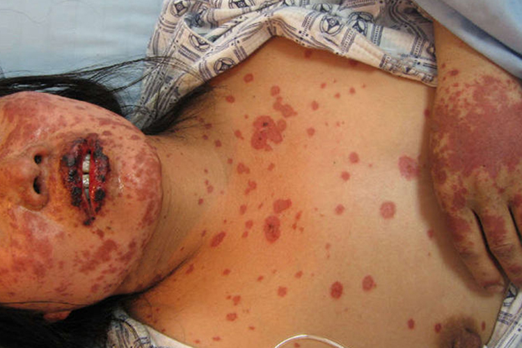 重症多形红斑型药疹图