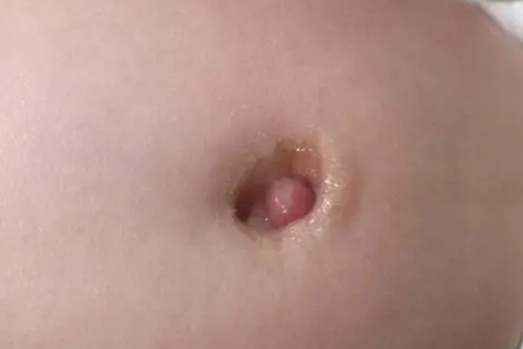 新生儿脐茸图 新生儿脐茸图