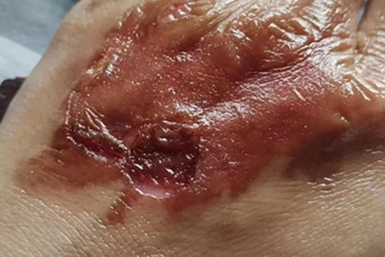 二度烫伤手背渗液图