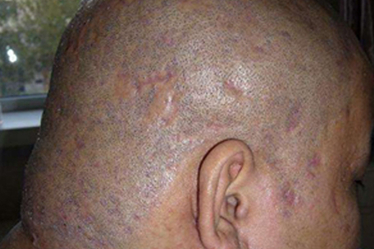 聚合性痤疮头皮瘢痕图 聚合性痤疮头皮瘢痕图