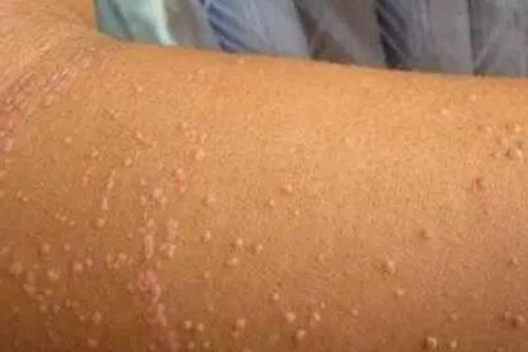 疣状表皮发育不良小疙瘩图