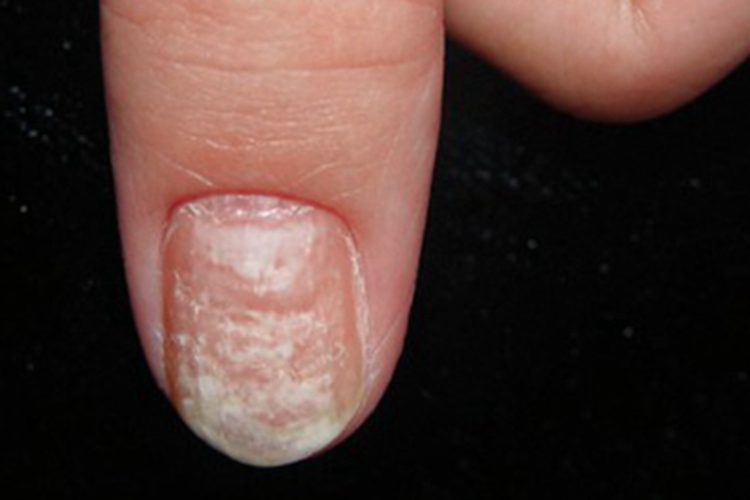 白色浅表型甲真菌病手指甲症状图