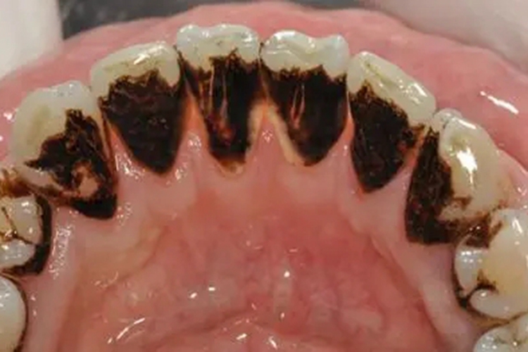 牙结石指数3度图 牙结石指数3度图